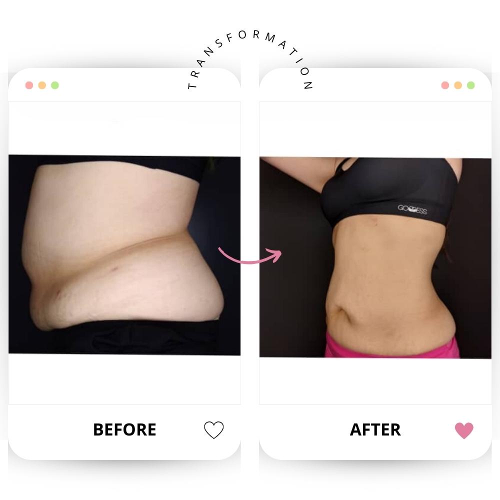 emsculpt neo body transformation before after (1)